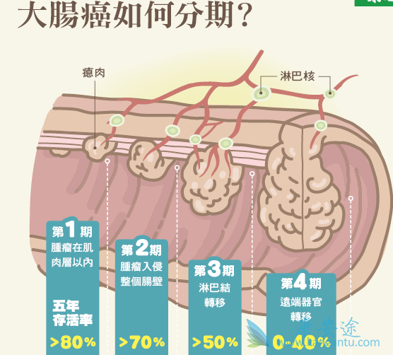 大肠癌症状 大肠癌症状