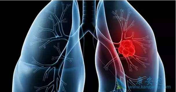 肺癌骨转移症状 肺癌骨转移症状