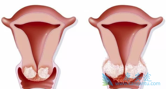宫颈癌症状 宫颈癌症状