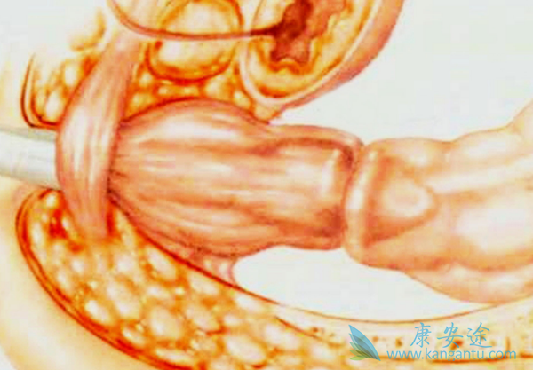 直肠癌症状 直肠癌症状