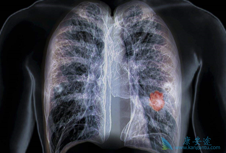 肺癌晚期症状 肺癌晚期症状