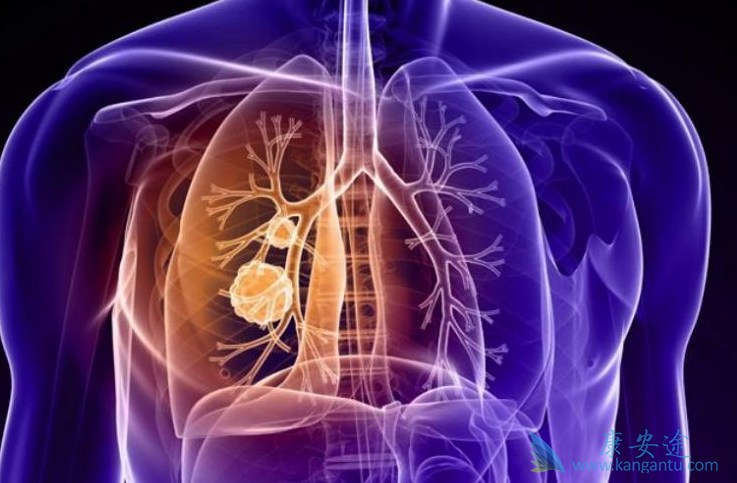 肺癌晚期治疗 肺癌晚期治疗