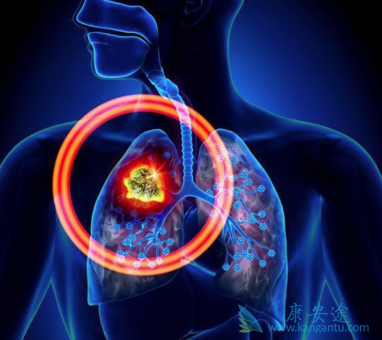 肺癌晚期症状 肺癌晚期症状