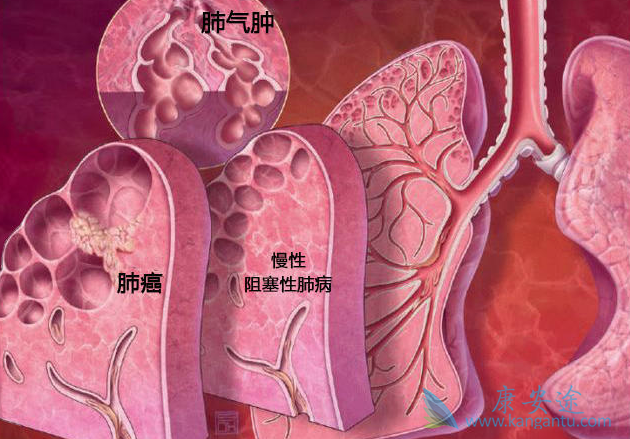 肺癌晚期怎么治疗 肺癌晚期怎么治疗