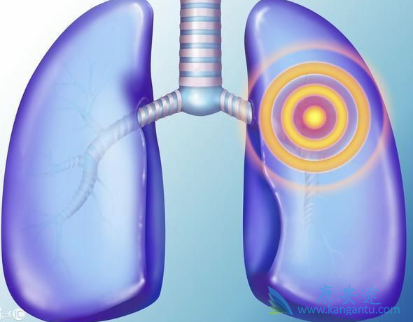 肺癌晚期的症状 肺癌晚期的症状