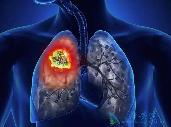 肺癌晚期传染吗 肺癌晚期传染吗