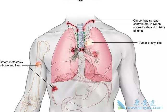 肺癌晚期化疗 肺癌晚期化疗