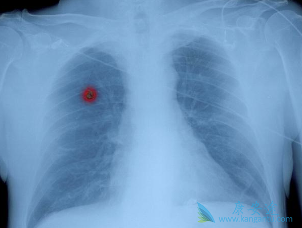 晚期肺癌治疗 晚期肺癌治疗