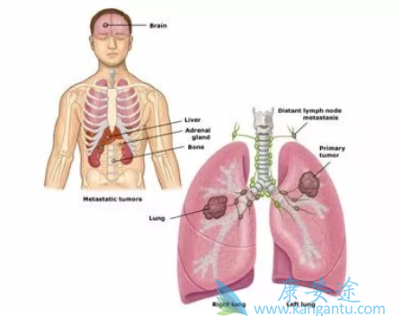 非小细胞肺癌 非小细胞肺癌