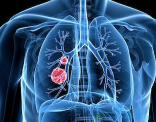 肺癌的治疗方法 肺癌的治疗方法