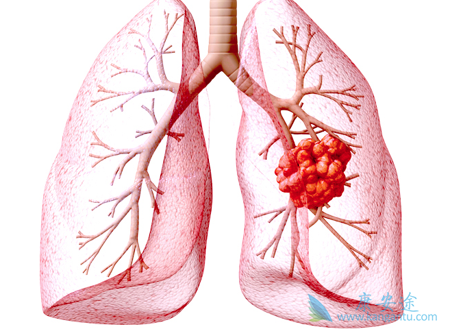 肺癌的治疗 肺癌的治疗
