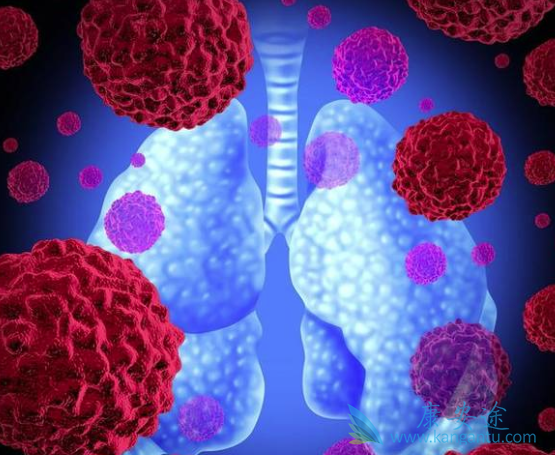 肺癌的症状 肺癌的症状