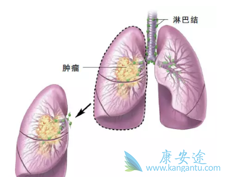 非小细胞肺癌 非小细胞肺癌