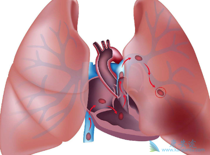 肺癌生物治疗 肺癌生物治疗