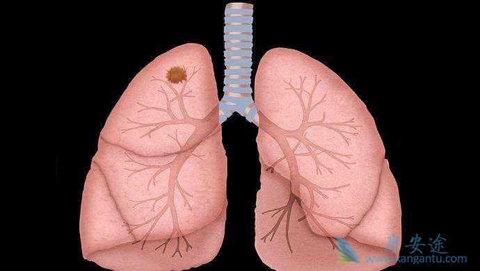 非小细胞肺癌 非小细胞肺癌