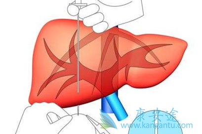 慢性丙肝症状 慢性丙肝症状