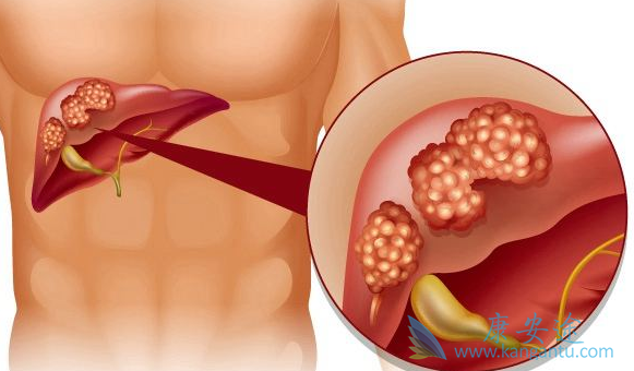 丙肝的症状有哪些 丙肝的症状有哪些