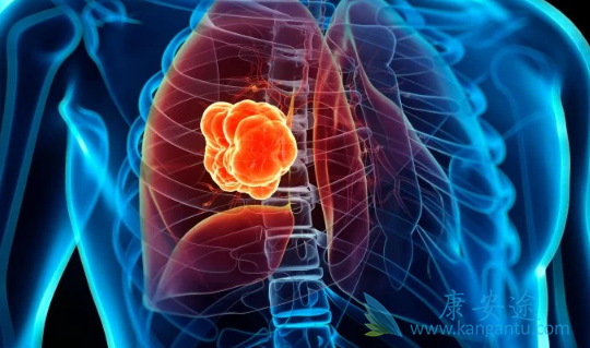 肺癌会传染吗 肺癌会传染吗