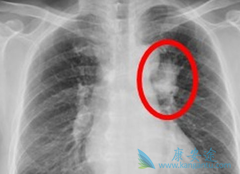 肺癌化疗 肺癌化疗