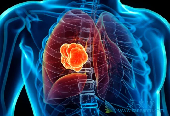 肺癌脑转移 肺癌脑转移