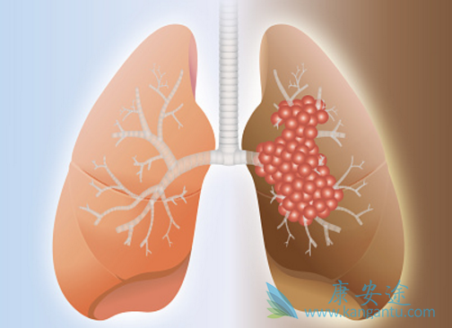 肺癌晚期 肺癌晚期