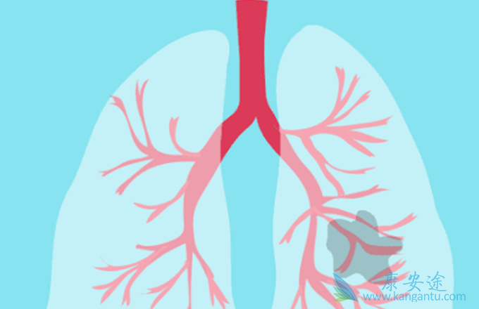 肺癌复发症状 肺癌复发症状