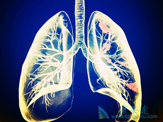 肺癌脑转移 肺癌脑转移