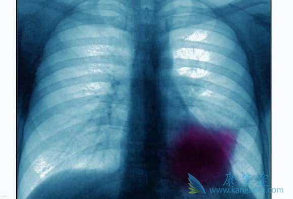 晚期肺癌 晚期肺癌