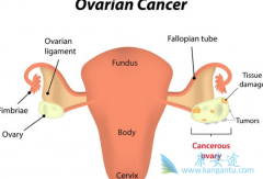 ��������(Olaparib)�����ѳ���ʹ���߻�ø�������