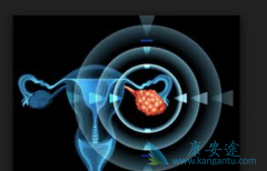 ��������(Olaparib)Ϊ�����ѳ������ߴ�������ϣ��