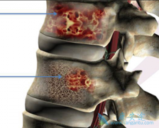 ����������ƣ���Ƕ෢�Թ�����֢״�е�һ��