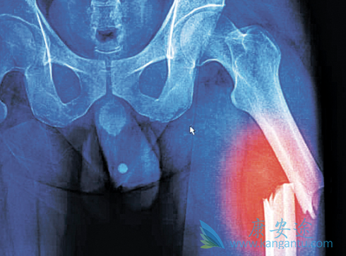 多发骨髓瘤 多发骨髓瘤