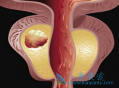 ����ǰ���ٰ�����ʹ�ð�������(Abiraterone)Ԥ�����