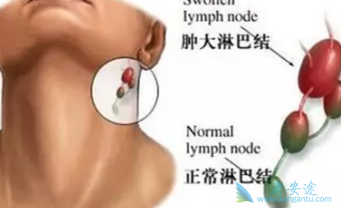 淋巴癌的症状 淋巴癌的症状