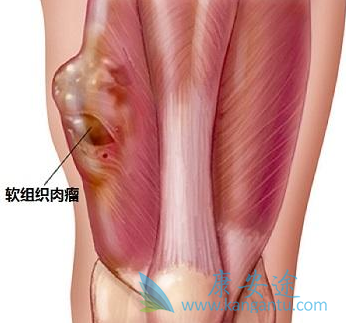 软组织肉瘤 软组织肉瘤