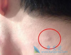 �����ܰͰ�ԭ������Щ���ٴ��϶�����Щ�ܰͰ���֢״��