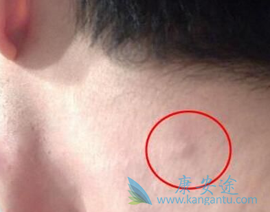 淋巴癌的症状 淋巴癌的症状