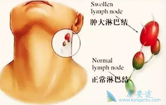 鼻咽癌症状 鼻咽癌症状