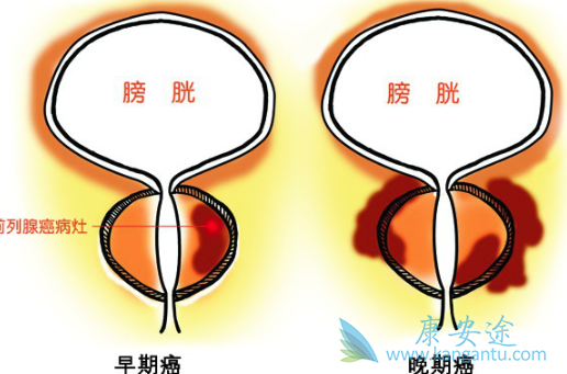 前列腺癌症状 前列腺癌症状