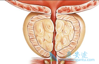 前列腺癌能活多久 前列腺癌能活多久