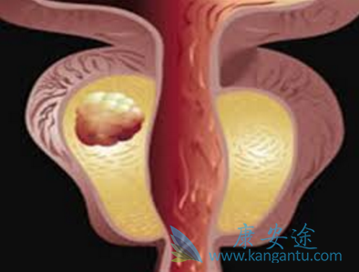 阿比特龙 阿比特龙