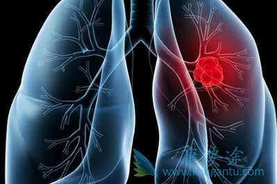 肺癌早期症状 肺癌早期症状