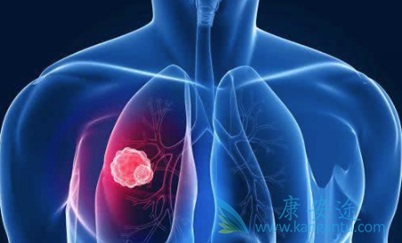 肺癌晚期还能活多久 肺癌晚期还能活多久