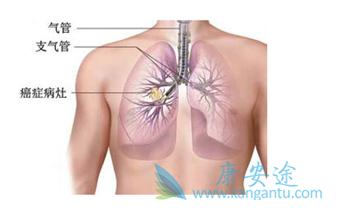 肺癌晚期会传染吗 肺癌晚期会传染吗