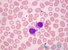 ����Bϵ�ܰ�ϸ����Ѫ���Ĳ���ԭ��֢״