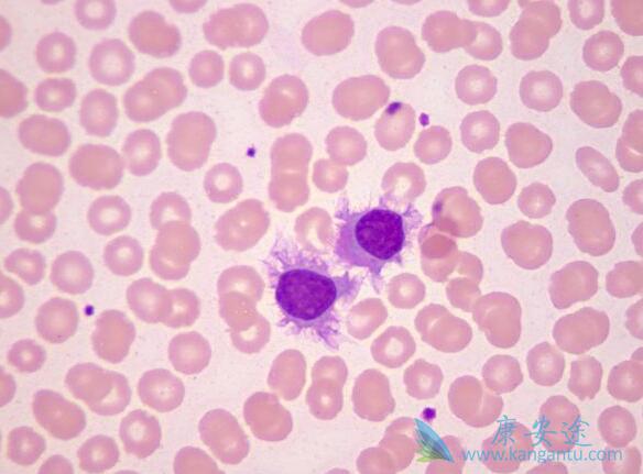 急性B系淋巴细胞白血病 急性B系淋巴细胞白血病