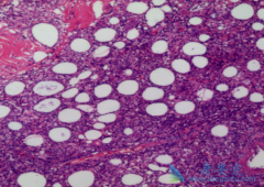 ����������(Brentuximab)ΪCTCLȺ���ṩһ���µ�����ѡ��