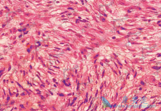 隆突性皮肤纤维肉瘤 隆突性皮肤纤维肉瘤