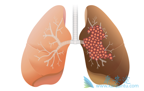 肺癌复发 肺癌复发