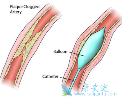 心脏支架手术后 心脏支架手术后